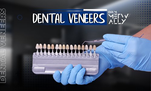 Dental veneers